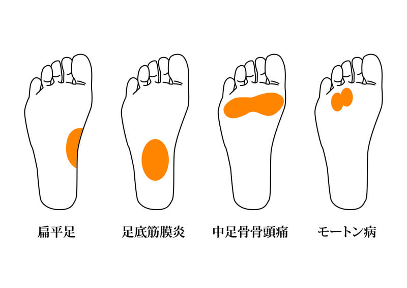 中足骨骨頭痛