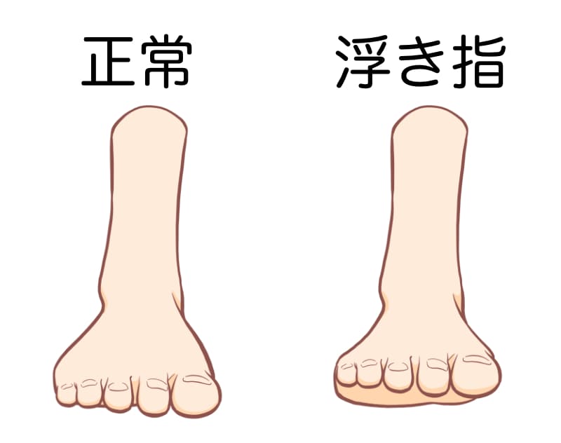 浮き指