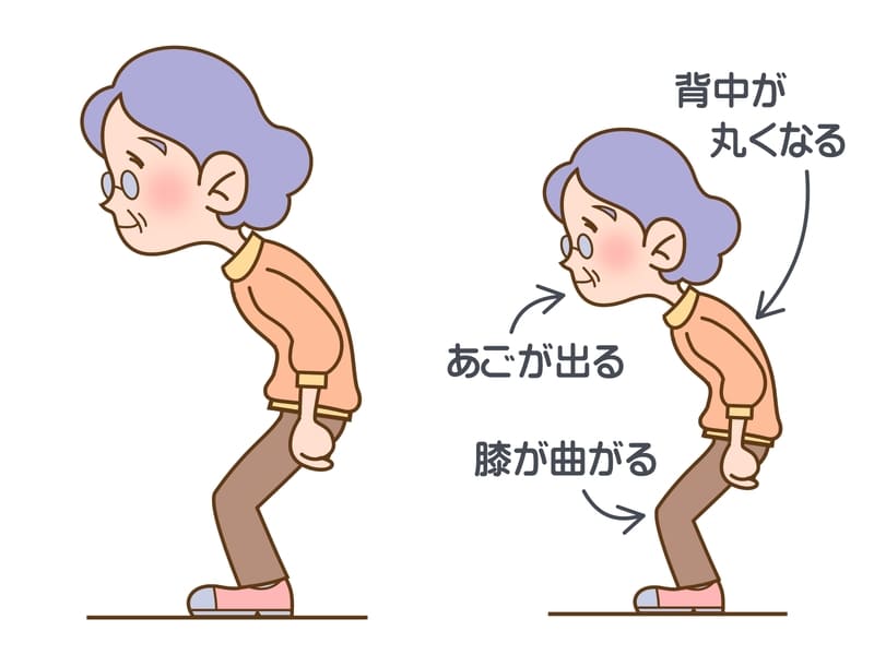 老人性円背