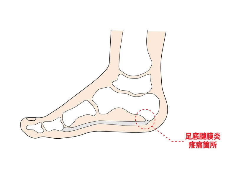 足底腱膜炎