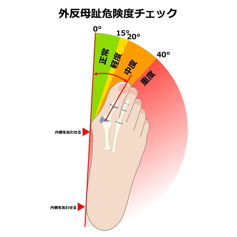 外反母趾