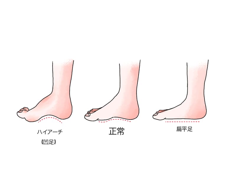 偏平足