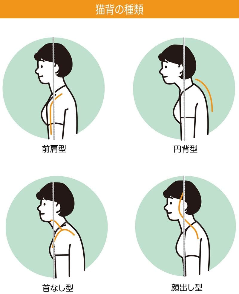 猫背の種類