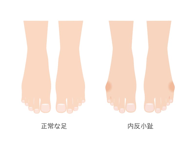 内反小趾