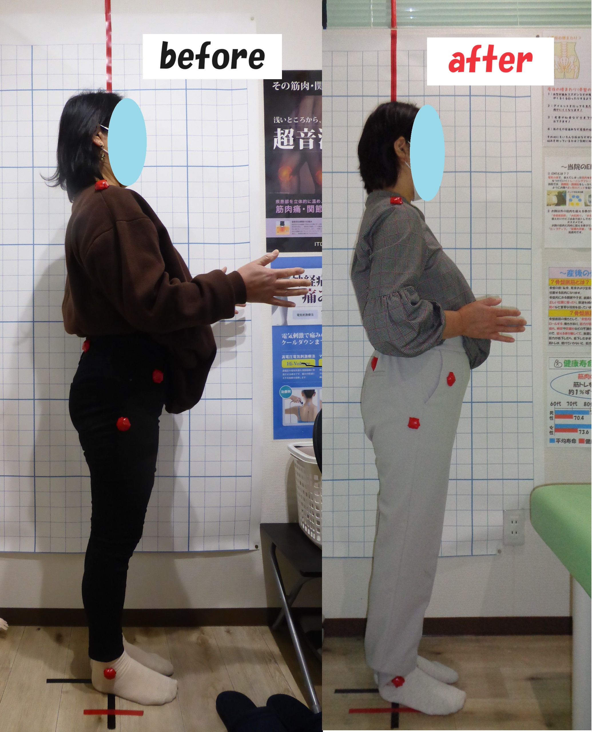 ぎっくり腰から狭窄症による腰痛 全身矯正