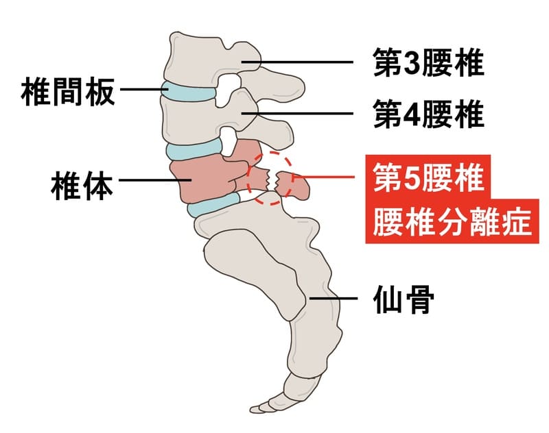 腰椎分離症
