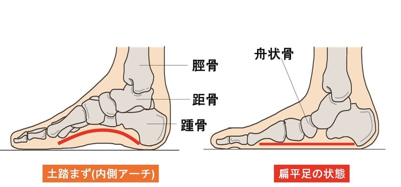 シーバー病の原因