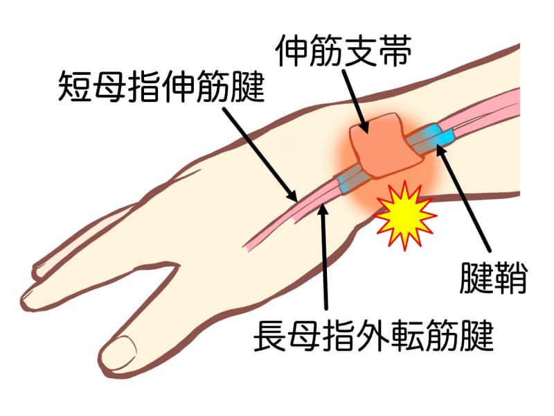 産後の腱鞘炎