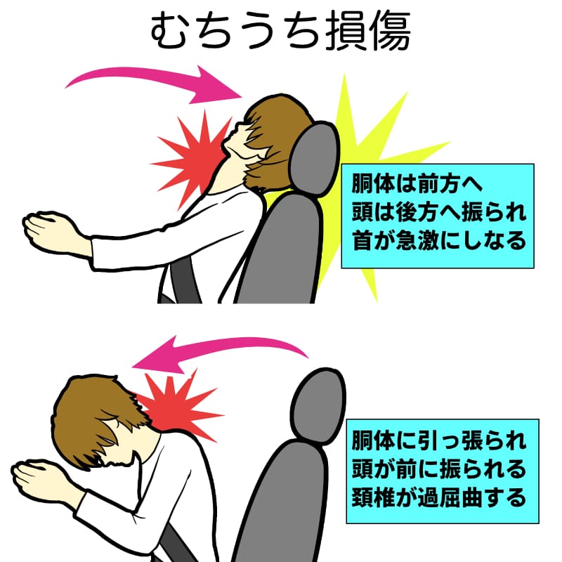 むちうち損傷
