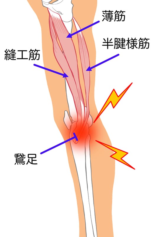 鵞足炎