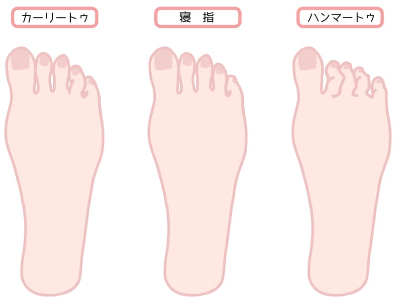 足趾の変形