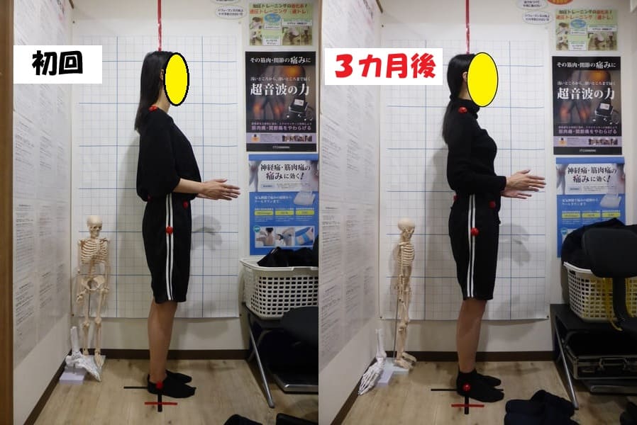 初回～３カ月後（横向き）