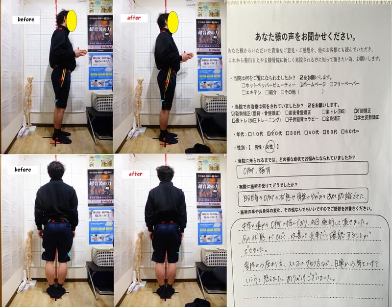 中学生の頃からＯ脚に悩んでいた　O脚矯正姿勢速圧プログラムモニター