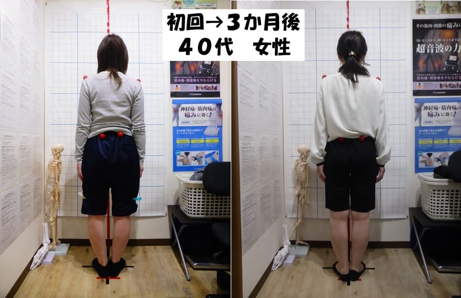O脚矯正・姿勢矯正｜豊田まえやま接骨院